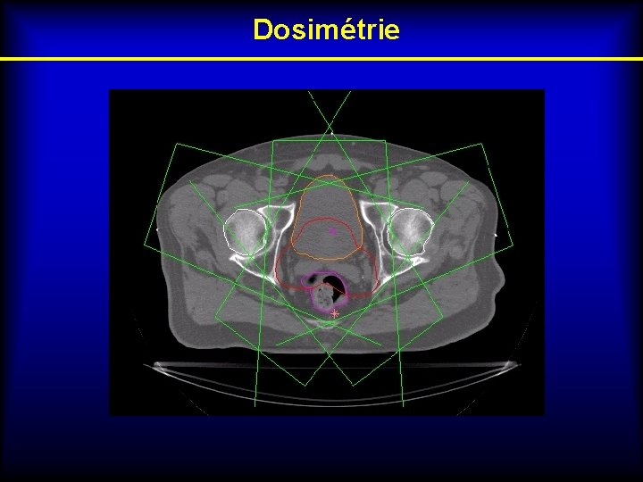 Dosimétrie 