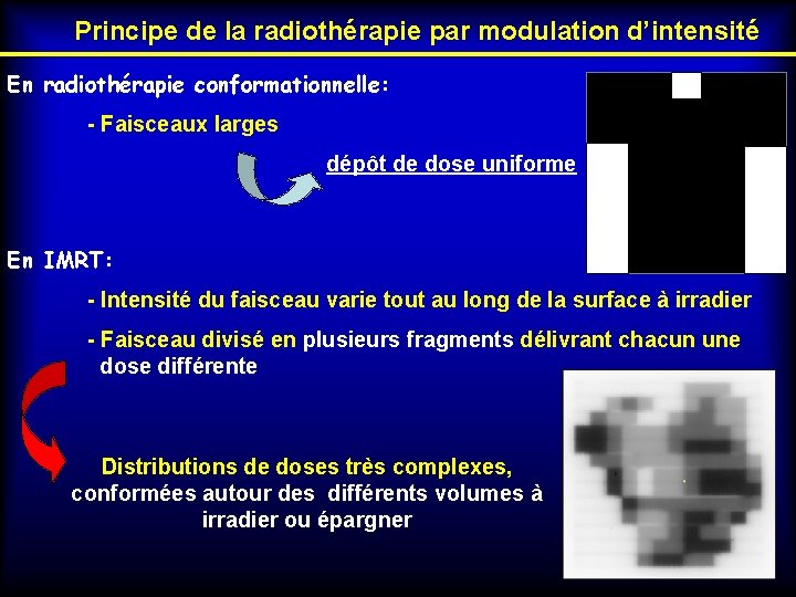 Principe de la radiothérapie par modulation d’intensité En radiothérapie conformationnelle: - Faisceaux larges dépôt