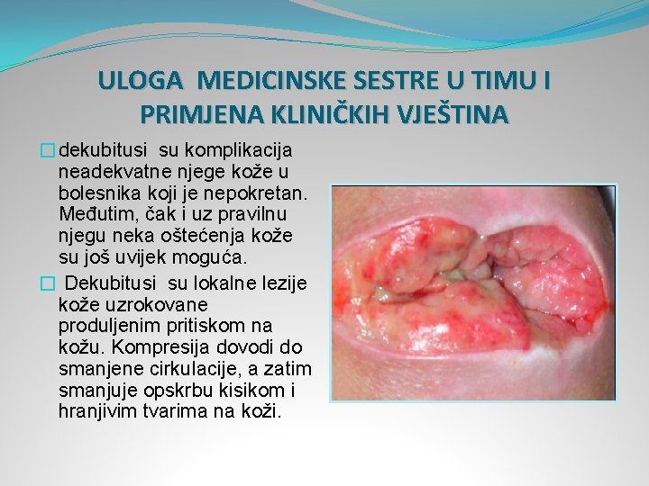 ULOGA MEDICINSKE SESTRE U TIMU I PRIMJENA KLINIČKIH VJEŠTINA �dekubitusi su komplikacija neadekvatne njege