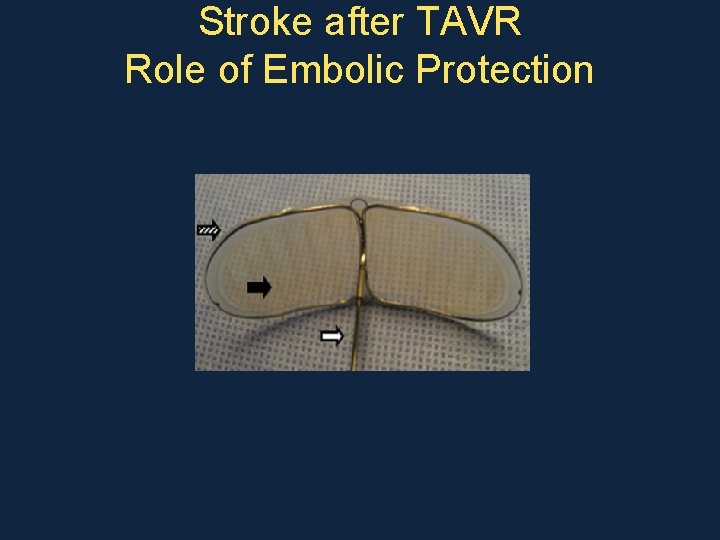 Stroke after TAVR Role of Embolic Protection 