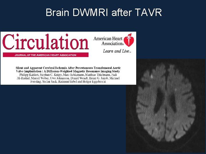 Brain DWMRI after TAVR 