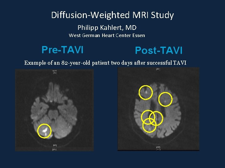 Diffusion-Weighted MRI Study Philipp Kahlert, MD West German Heart Center Essen Pre-TAVI Post-TAVI Example