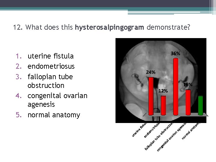 12. What does this hysterosalpingogram demonstrate? 1. uterine fistula 2. endometriosus 3. fallopian tube 12. What does this hysterosalpingogram demonstrate? 1. uterine fistula 2. endometriosus 3. fallopian tube