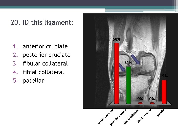 20. ID this ligament: 1. 2. 3. 4. 5. anterior cruciate posterior cruciate fibular 20. ID this ligament: 1. 2. 3. 4. 5. anterior cruciate posterior cruciate fibular