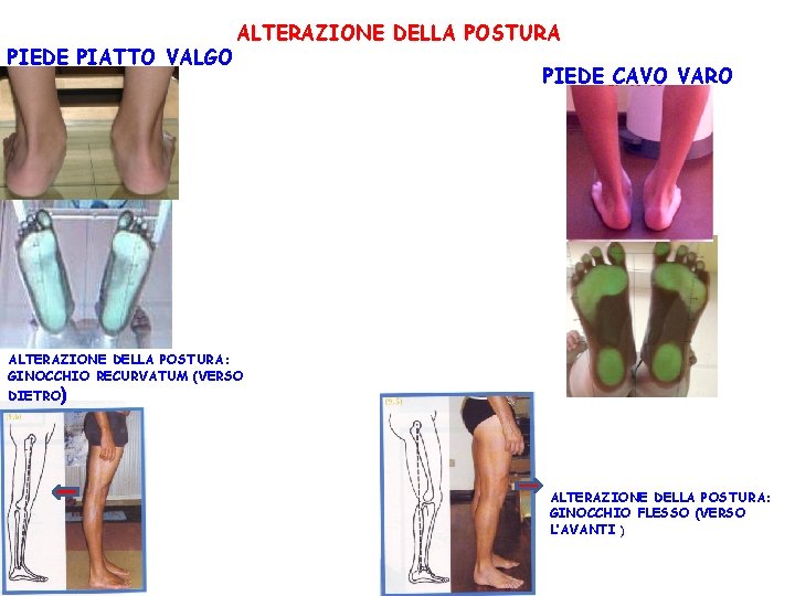 PIEDE PIATTO VALGO ALTERAZIONE DELLA POSTURA PIEDE CAVO VARO ALTERAZIONE DELLA POSTURA: GINOCCHIO RECURVATUM