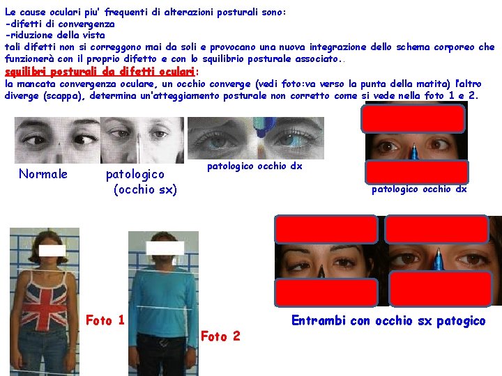 Le cause oculari piu’ frequenti di alterazioni posturali sono: -difetti di convergenza -riduzione della