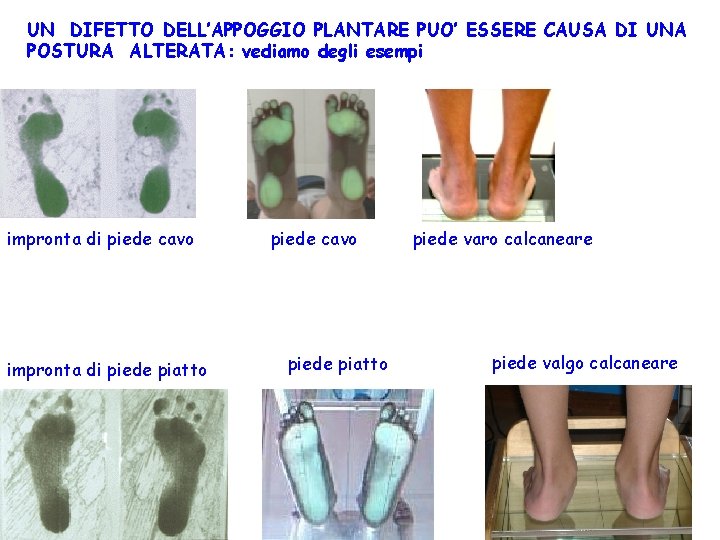 UN DIFETTO DELL’APPOGGIO PLANTARE PUO’ ESSERE CAUSA DI UNA POSTURA ALTERATA: vediamo degli esempi