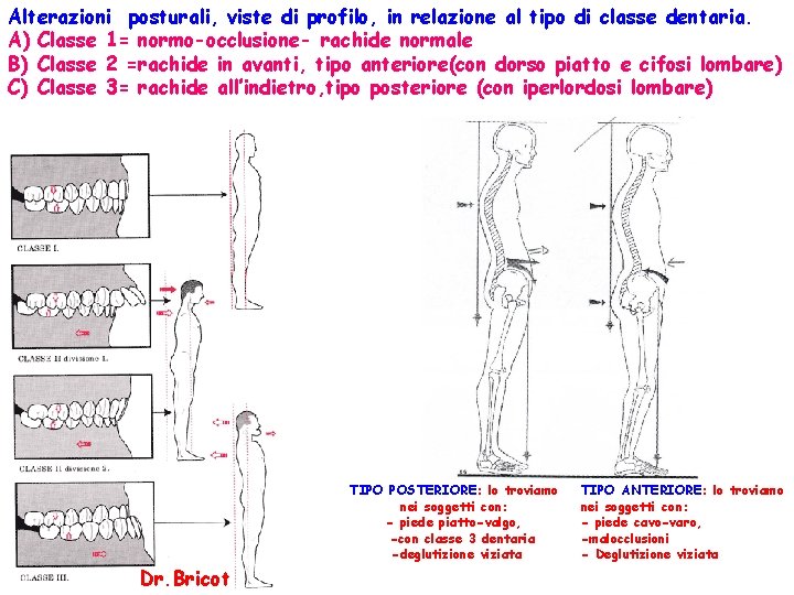 Alterazioni posturali, viste di profilo, in relazione al tipo di classe dentaria. A) Classe