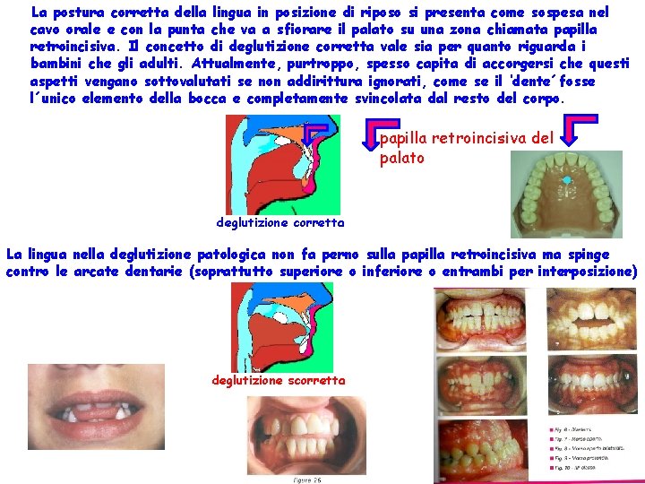 La postura corretta della lingua in posizione di riposo si presenta come sospesa nel