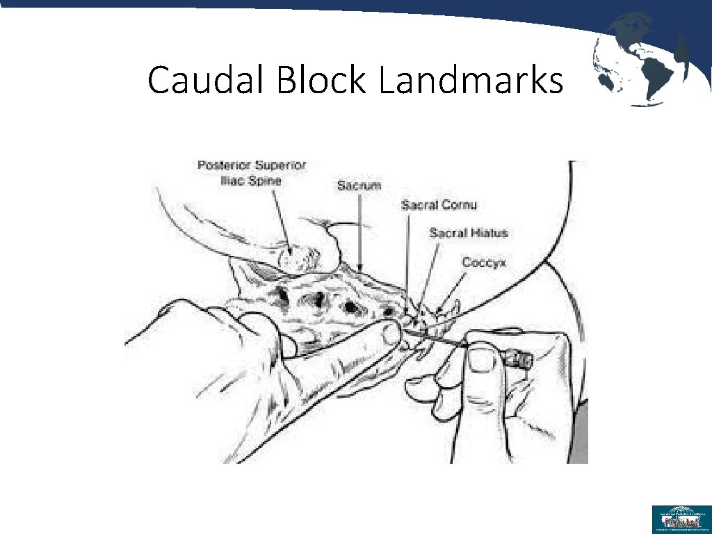 Caudal Block Landmarks 