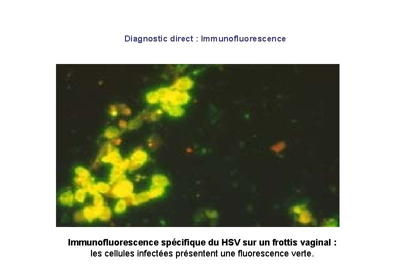 Diagnostic direct : Immunofluorescence spécifique du HSV sur un frottis vaginal : les cellules