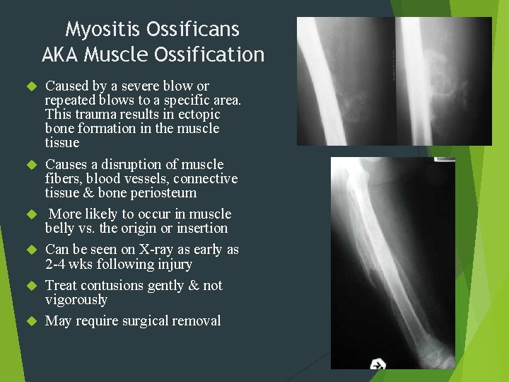 Myositis Ossificans AKA Muscle Ossification Caused by a severe blow or repeated blows to