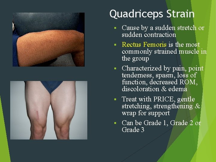 Quadriceps Strain Cause by a sudden stretch or sudden contraction Rectus Femoris is the