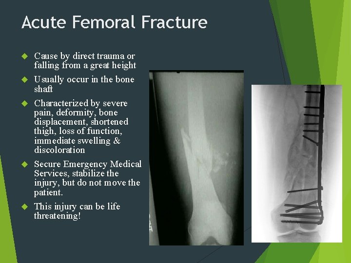 Acute Femoral Fracture Cause by direct trauma or falling from a great height Usually