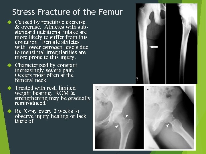 Stress Fracture of the Femur Caused by repetitive exercise & overuse. Athletes with substandard