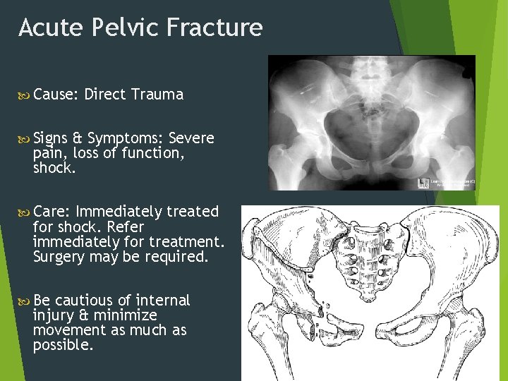 Acute Pelvic Fracture Cause: Direct Trauma Signs & Symptoms: Severe pain, loss of function,