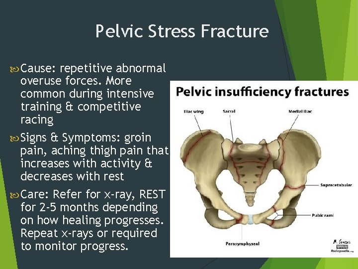 Pelvic Stress Fracture Cause: repetitive abnormal overuse forces. More common during intensive training &