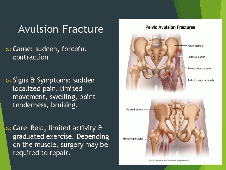 Avulsion Fracture Cause: sudden, forceful contraction Signs & Symptoms: sudden localized pain, limited movement,