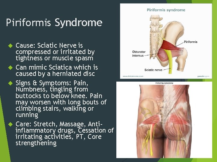 Piriformis Syndrome Cause: Sciatic Nerve is compressed or irritated by tightness or muscle spasm