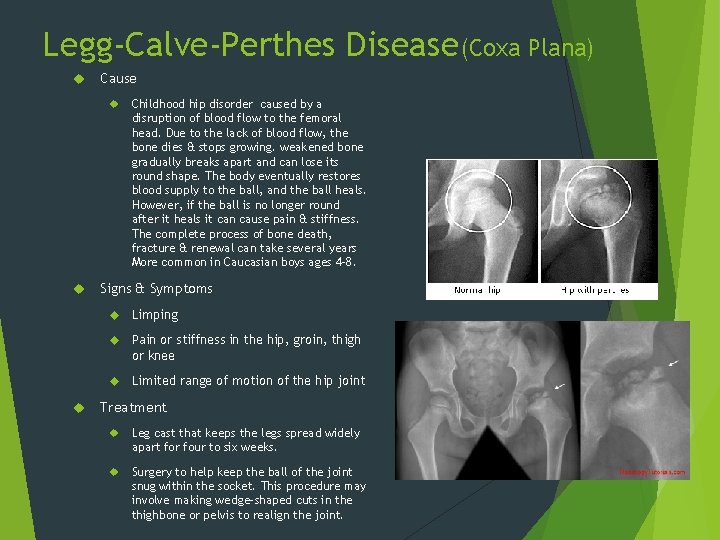 Legg-Calve-Perthes Disease(Coxa Plana) Cause Childhood hip disorder caused by a disruption of blood flow
