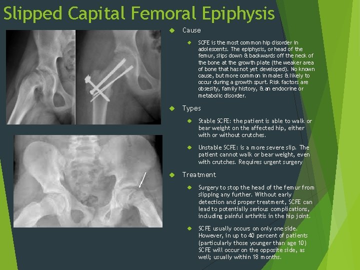 Slipped Capital Femoral Epiphysis Cause SCFE is the most common hip disorder in adolescents.