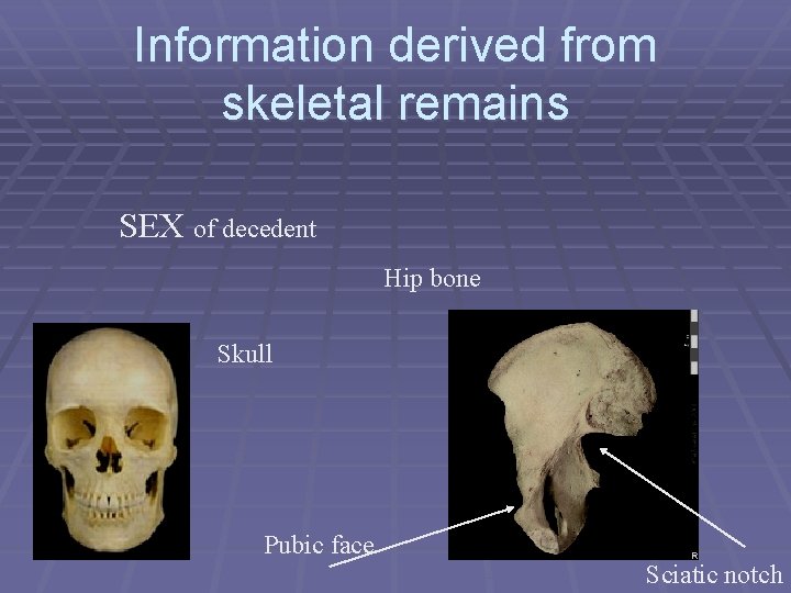 Information derived from skeletal remains SEX of decedent Hip bone Skull Pubic face Sciatic