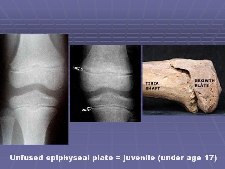 Unfused epiphyseal plate = juvenile (under age 17) 