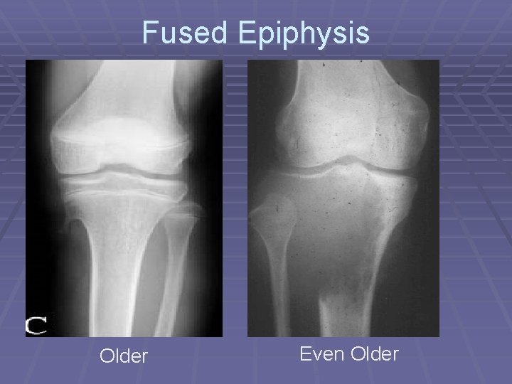 Fused Epiphysis Older Even Older 
