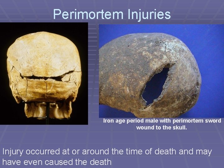 Perimortem Injuries Iron age period male with perimortem sword wound to the skull. Injury