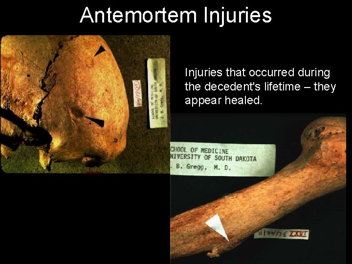Antemortem Injuries that occurred during the decedent's lifetime – they appear healed. 