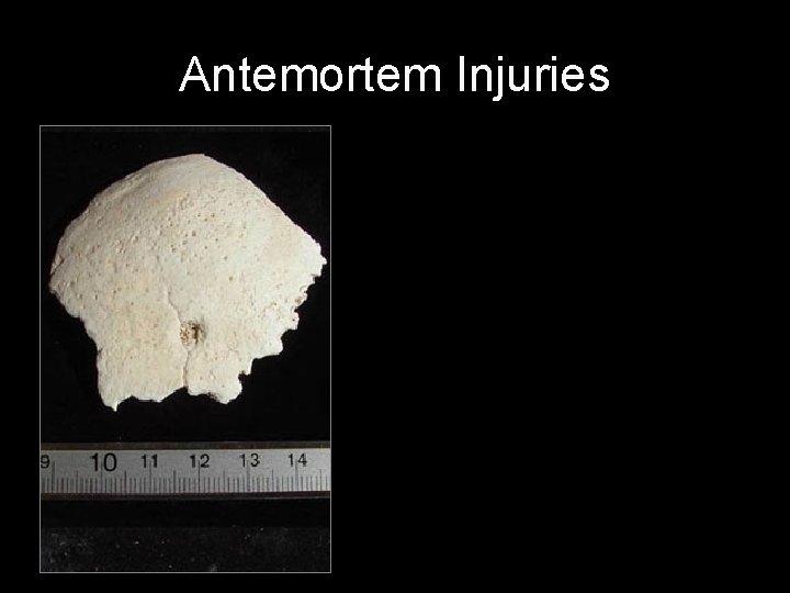 Antemortem Injuries 