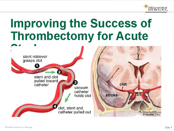 Improving the Success of Thrombectomy for Acute Stroke Slide 9 Improving the Success of Thrombectomy for Acute Stroke Slide 9