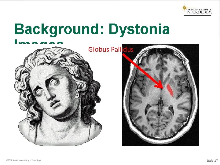 Background: Dystonia Images Globus Pallidus Slide 27 Background: Dystonia Images Globus Pallidus Slide 27