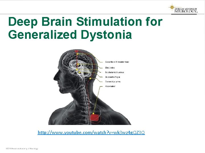 Deep Brain Stimulation for Generalized Dystonia http: //www. youtube. com/watch? v=wk 3 wz 4 Deep Brain Stimulation for Generalized Dystonia http: //www. youtube. com/watch? v=wk 3 wz 4
