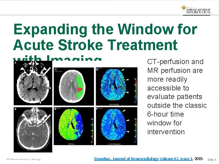 Expanding the Window for Acute Stroke Treatment CT-perfusion and with Imaging MR perfusion are Expanding the Window for Acute Stroke Treatment CT-perfusion and with Imaging MR perfusion are