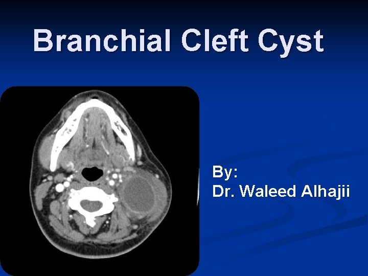 Branchial Cleft Cyst By: Dr. Waleed Alhajii 