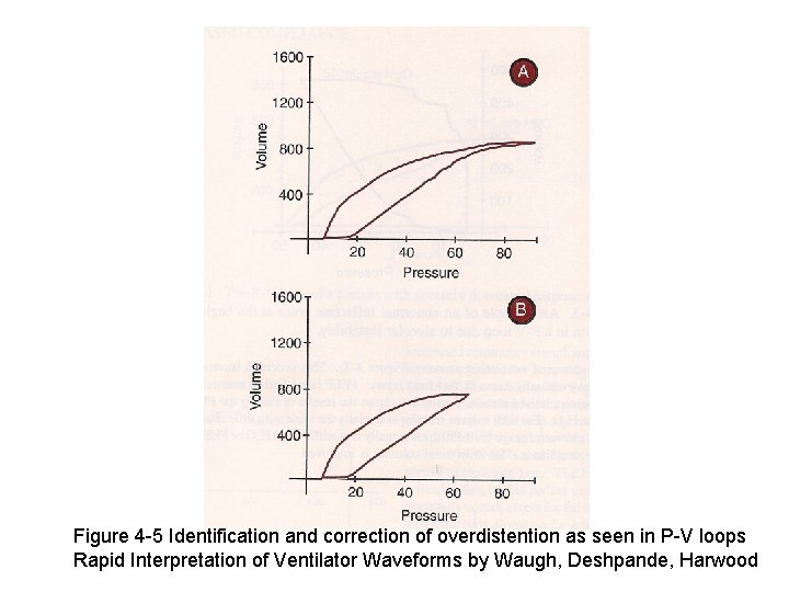 Figure 4 -5 Identification and correction of overdistention as seen in P-V loops Rapid
