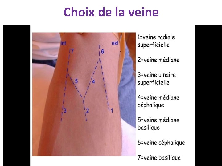 Choix de la veine 