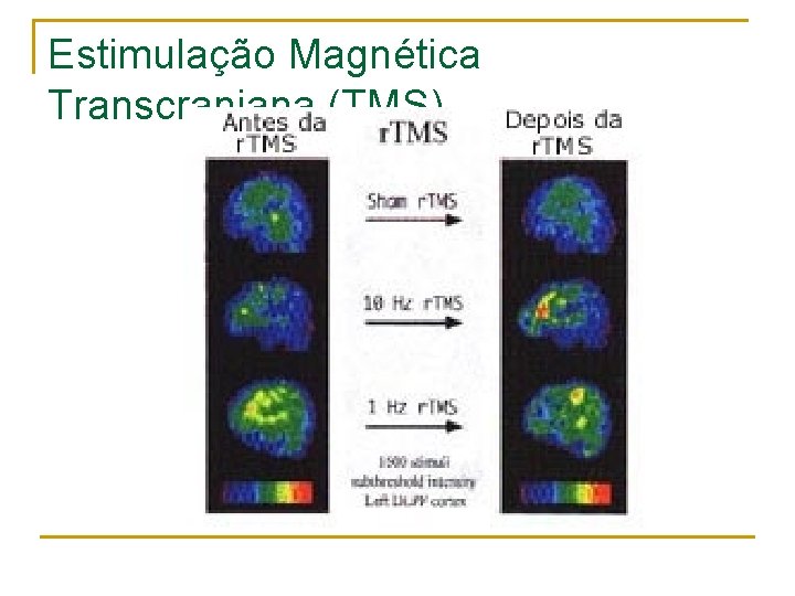 Estimulação Magnética Transcraniana (TMS) 