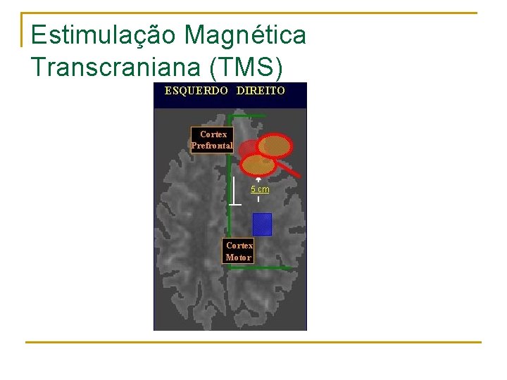 Estimulação Magnética Transcraniana (TMS) 