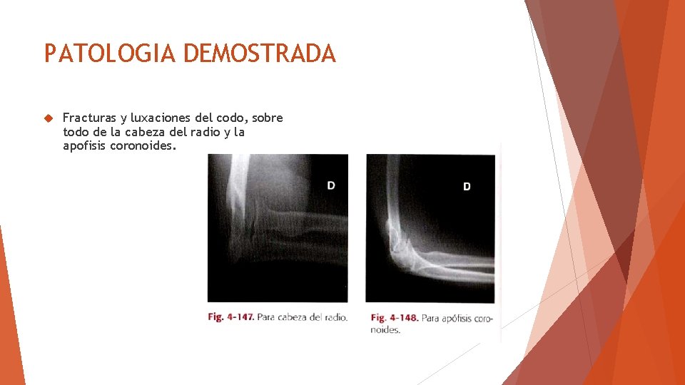 PATOLOGIA DEMOSTRADA Fracturas y luxaciones del codo, sobre todo de la cabeza del radio