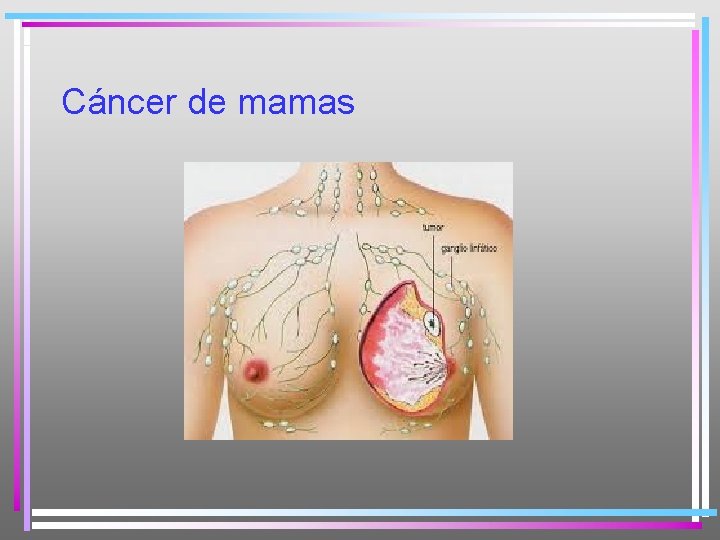 Cáncer de mamas 