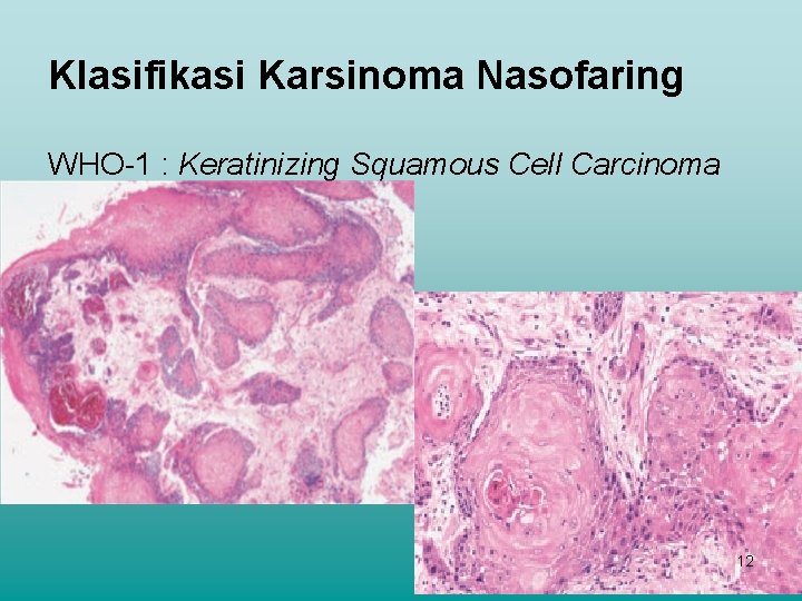Klasifikasi Karsinoma Nasofaring WHO-1 : Keratinizing Squamous Cell Carcinoma 12 