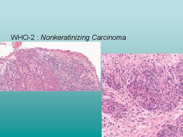 WHO-2 : Nonkeratinizing Carcinoma 13 