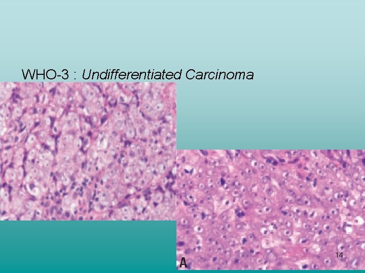 WHO-3 : Undifferentiated Carcinoma 14 