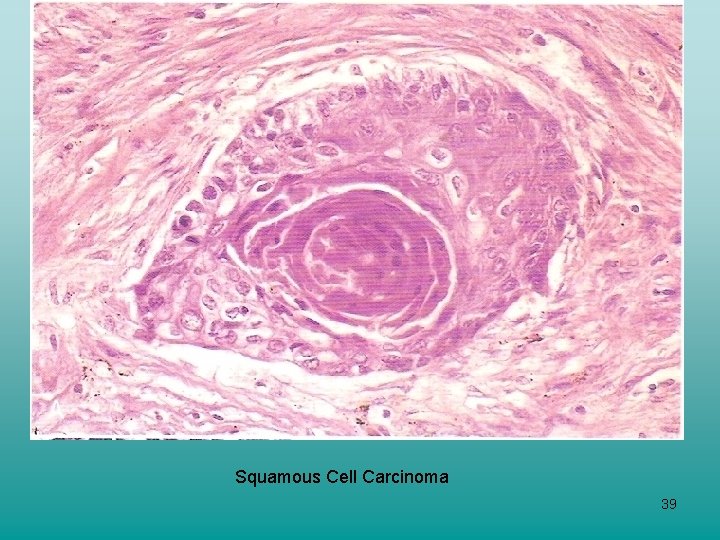 Squamous Cell Carcinoma 39 