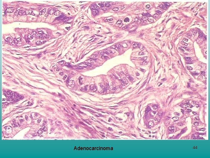 Adenocarcinoma 44 