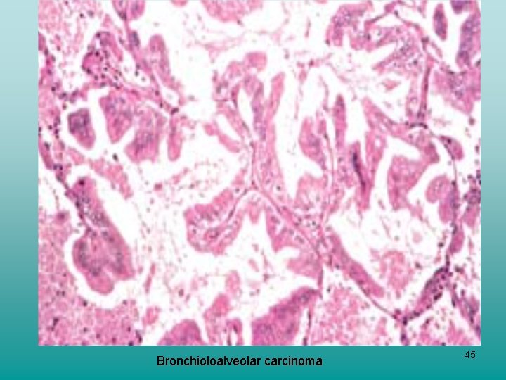 Bronchioloalveolar carcinoma 45 