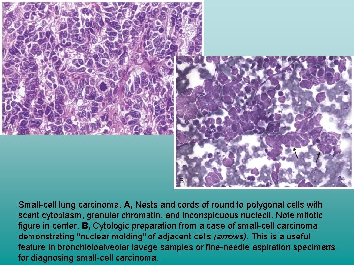 Small-cell lung carcinoma. A, Nests and cords of round to polygonal cells with scant