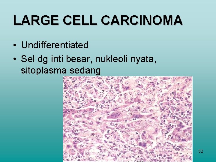 LARGE CELL CARCINOMA • Undifferentiated • Sel dg inti besar, nukleoli nyata, sitoplasma sedang